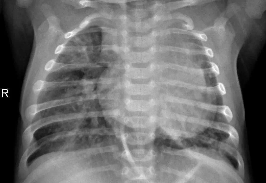 Hyper-model training on Chest X-Ray Images (Pneumonia)